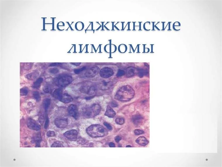 Симптомы и признаки неходжкинской лимфомы