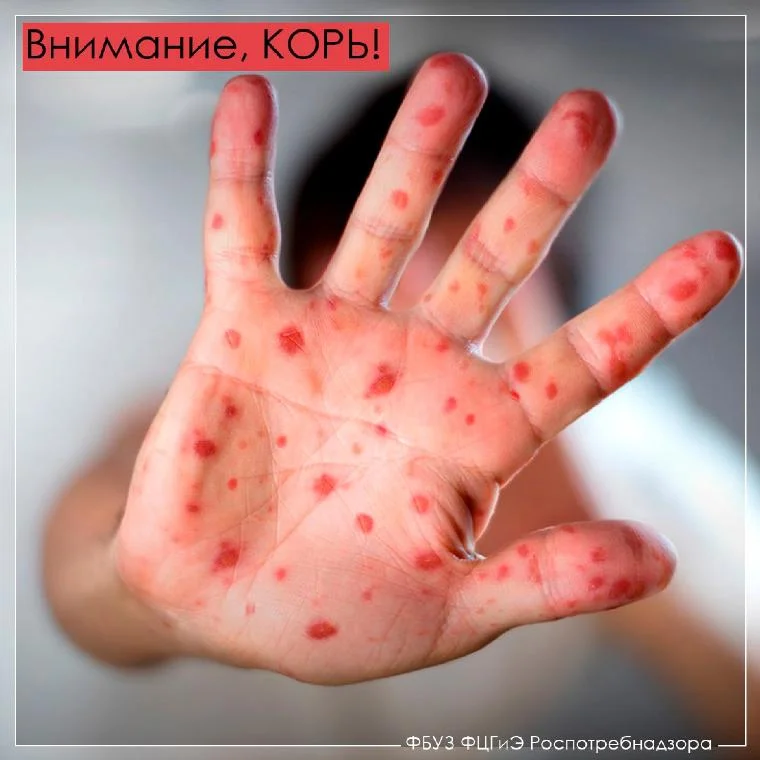 Внимание, корь!