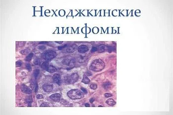 Симптомы и признаки неходжкинской лимфомы