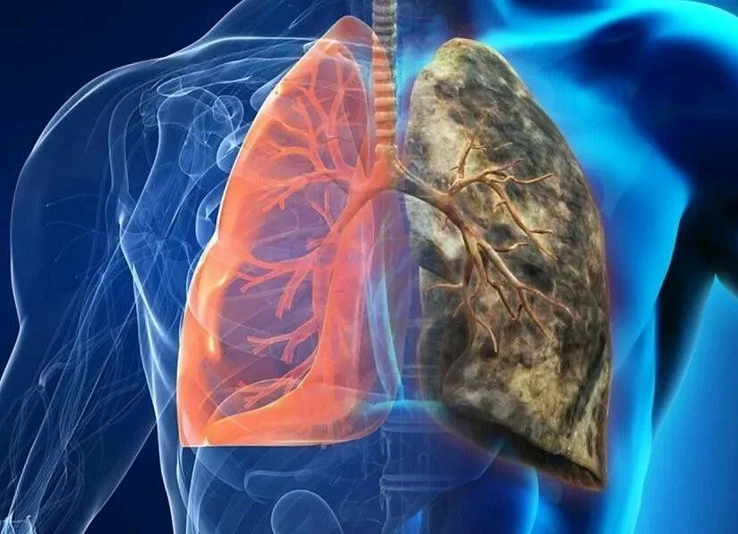 В период с 3 по 9 ноября в России проводится неделя профилактики рака легких