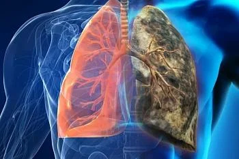 В период с 3 по 9 ноября в России проводится неделя профилактики рака легких